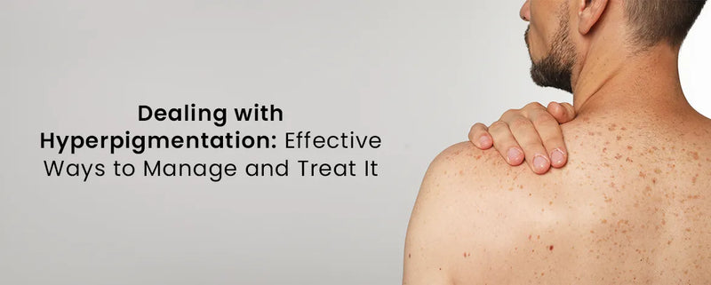 Dealing with Hyperpigmentation: Effective Ways to Manage and Treat It