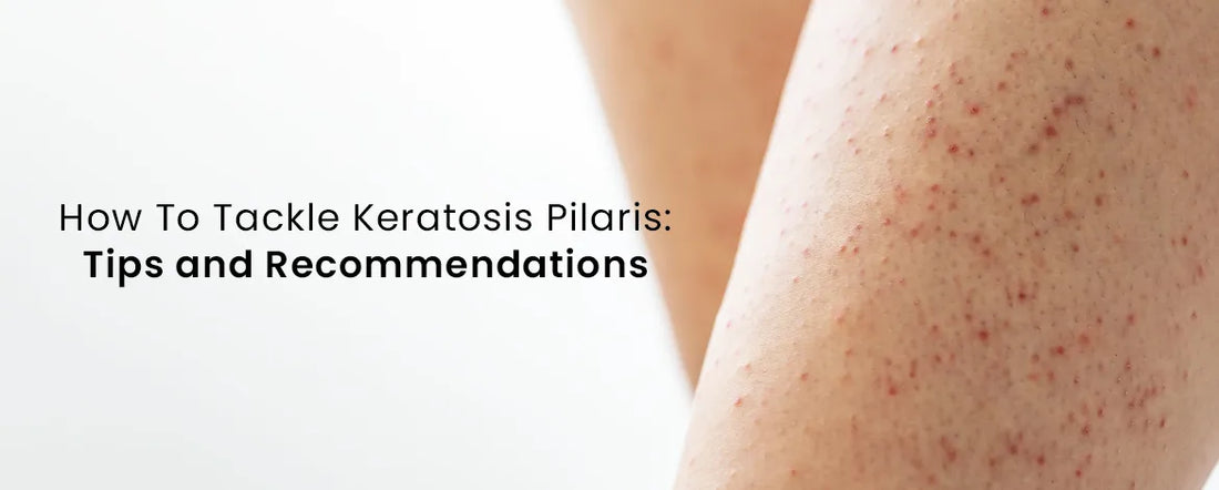 How To Tackle Keratosis Pilaris