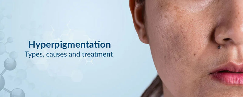 Dermatologist - Approved Best Ways to Treat Hyperpigmentation