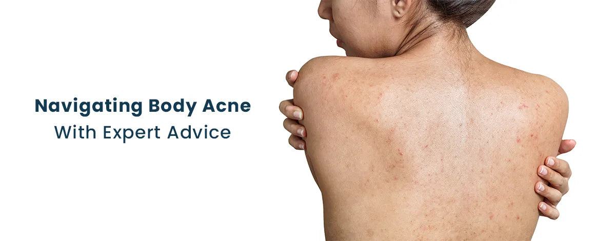 Navigating Body Acne with Expert Advice – FCL Skincare