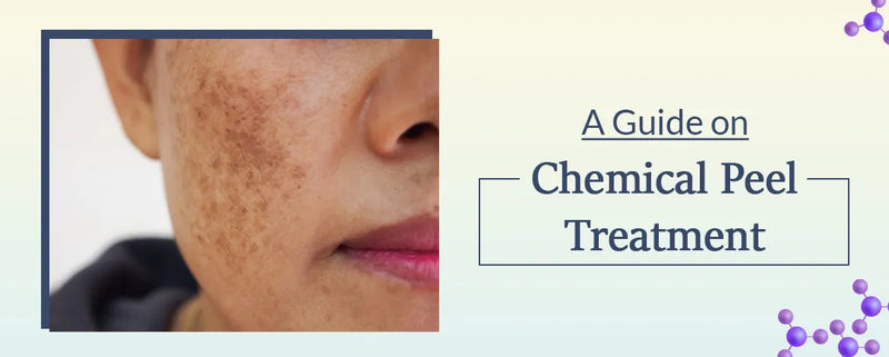 A Detailed Guide on Chemical Peel Treatment at-home