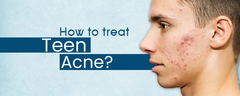 How to treat Teen Acne? Do’s & Don’ts of Acne