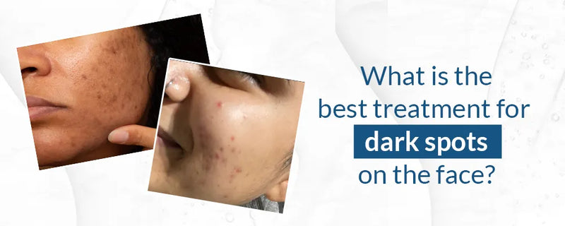 What is the best treatment for dark spots on the face?