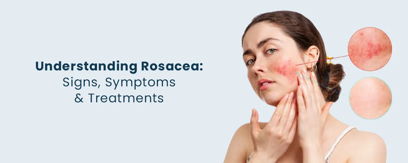 Understanding Rosacea: Signs, Symptoms, and Treatments