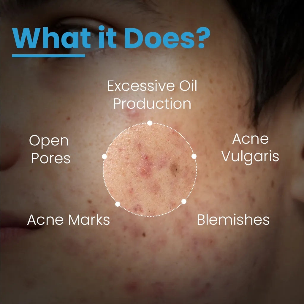 Alpha Beta Acne Gel