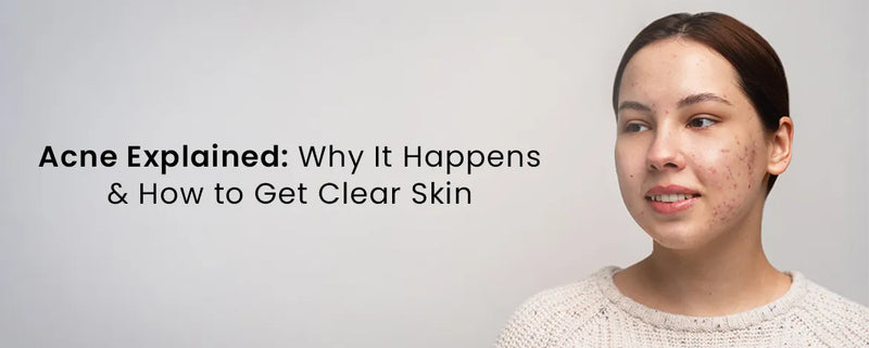 Acne Explained: Why It Happens & How to Get Clear Skin