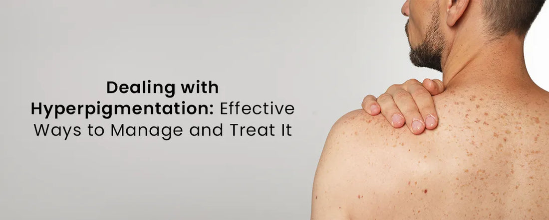 Dealing with Hyperpigmentation