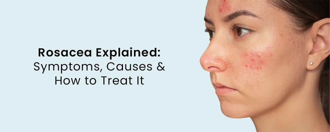 Rosacea Explained: Symptoms, Causes & How to Treat It
