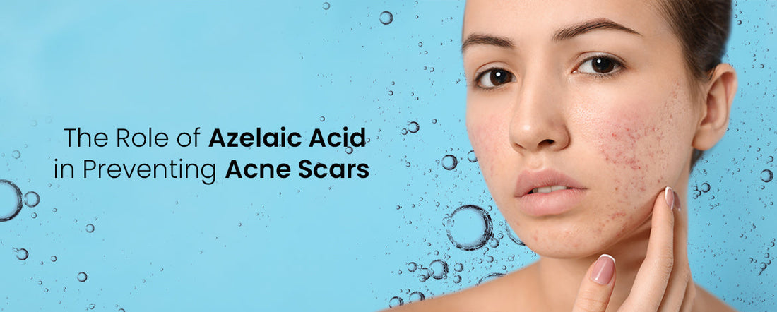 The Role of Azelaic Acid in Preventing Acne Scars