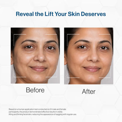 Face Lift Matrix